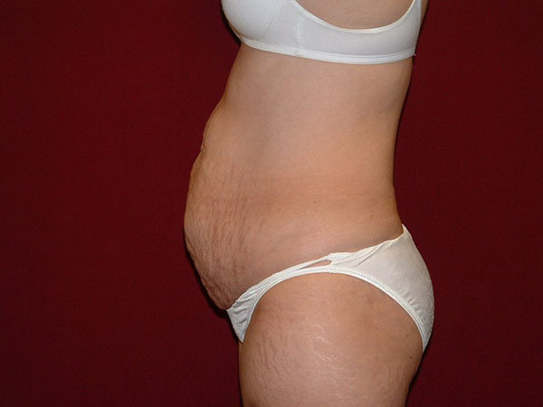 Tummy Tuck Patient 10 Before 2