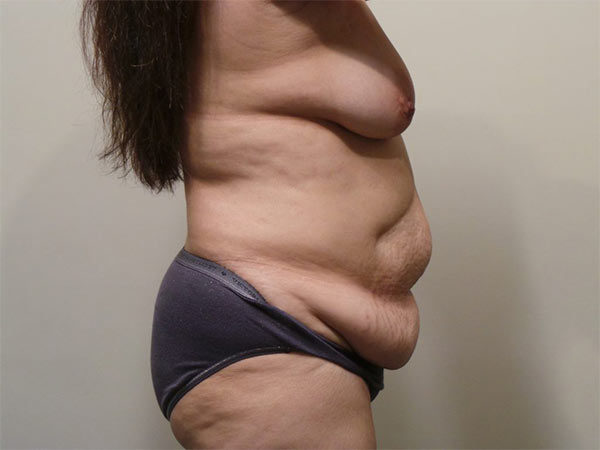 Tummy Tuck Patient 12 Before 2