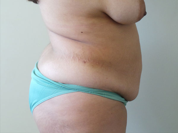Abdominoplasty Case 25 Before 2