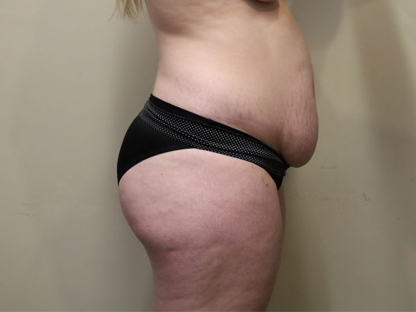 Abdominoplasty Case 26 Before 1