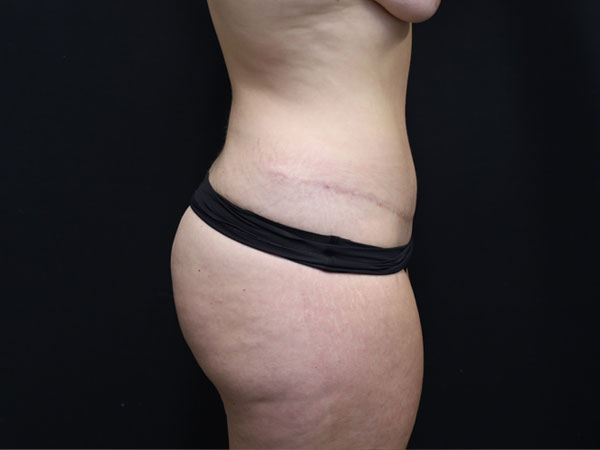Abdominoplasty Case 26 After 1
