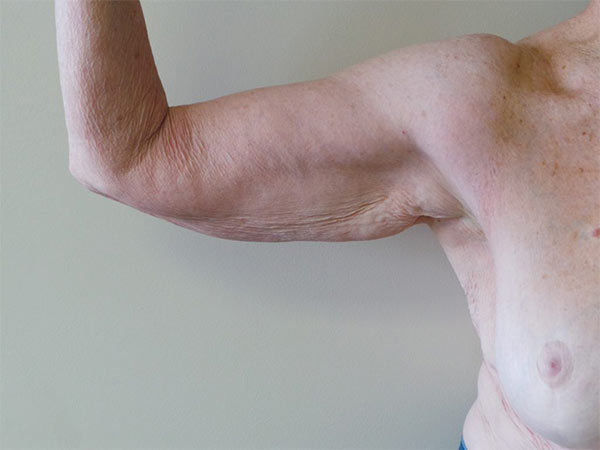 Arm Lift Patient 02 Before 2