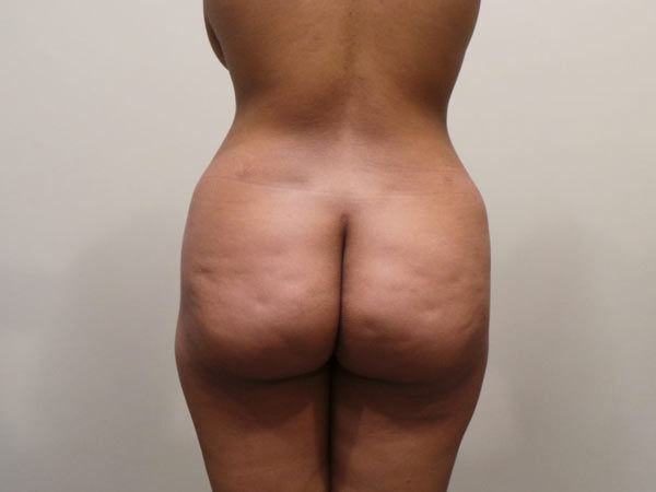 Brazilian Fat Transfer Patient 12 After 1