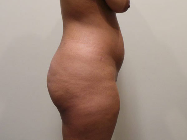 Brazilian Fat Transfer Patient 12 After 2