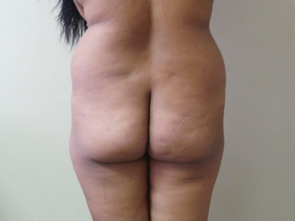 Brazilian Fat Transfer Patient 12 Before 1