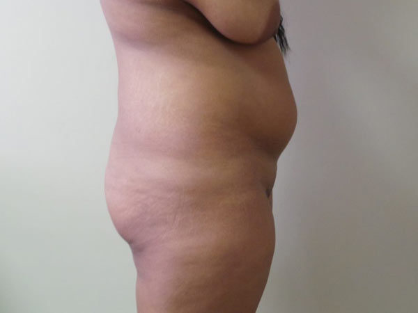 Brazilian Fat Transfer Patient 12 Before 2