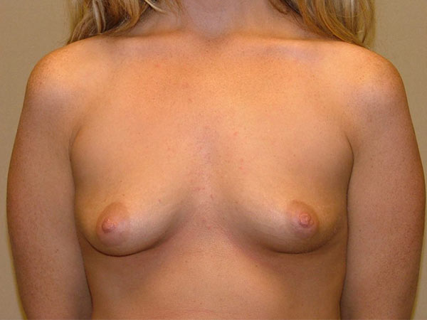 Breast Augmentation & Enhancement Patient Before