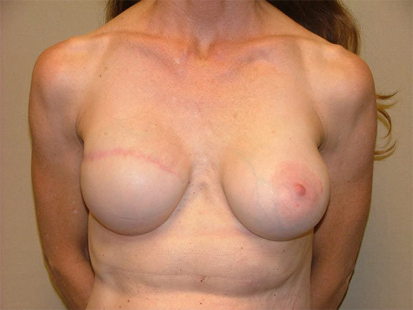 Breast Reconstruction Patient 01 After 1