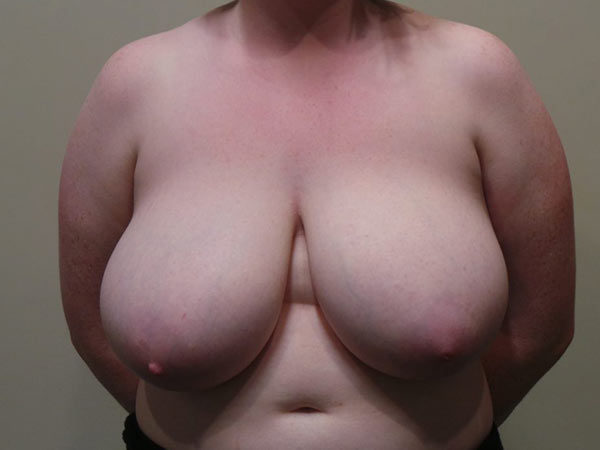 Breast Reduction Patient 03 Before 1