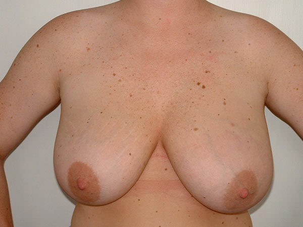 Breast Reduction Patient 10 Before 1