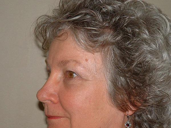 Brow Lift Patient 04 After 2