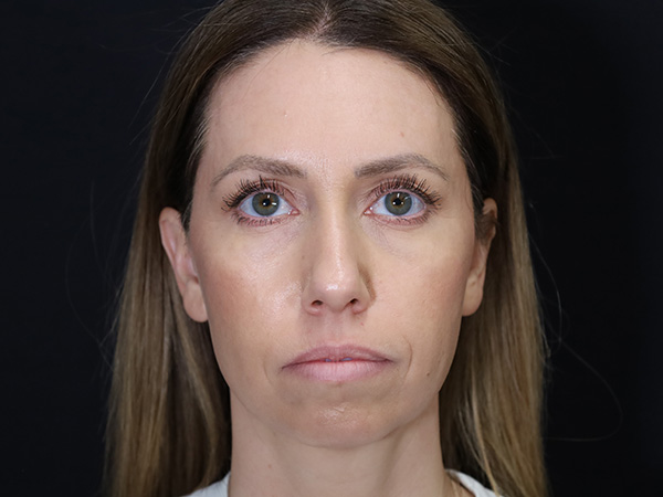 Chin Augmentation Patient 07 Before 1