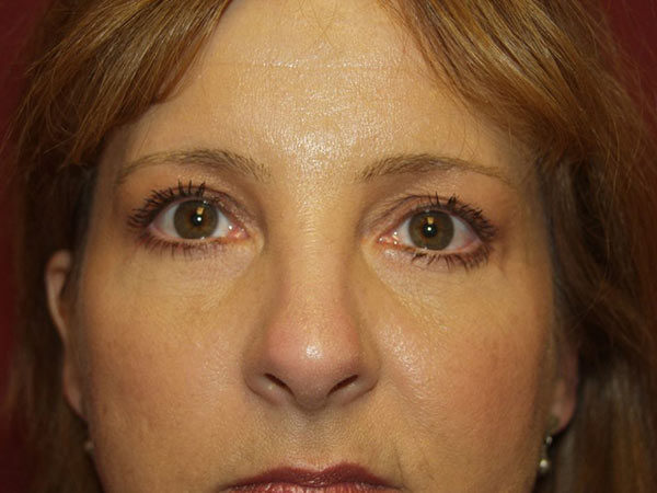 Eyelid Surgery Patient 12 After 1