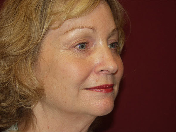 Eyelid Surgery Patient 21 After 2