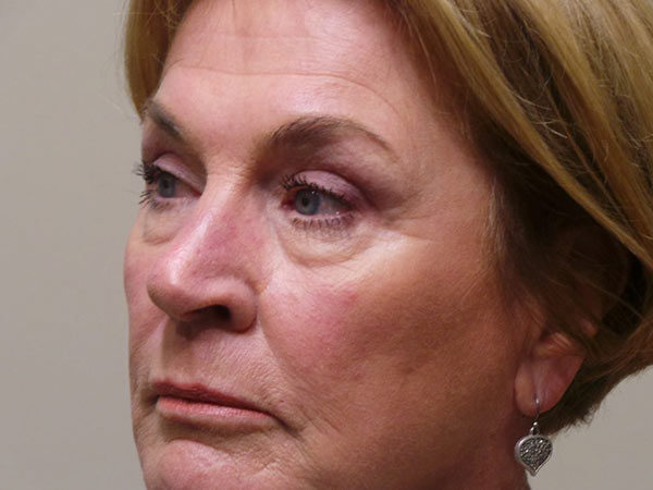 Eyelid Surgery Patient 05 After 1