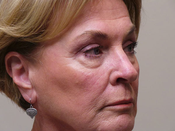 Eyelid Surgery Patient 05 After 2