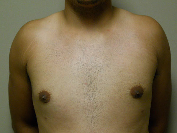 Gynecomastia Patient 11 After 1