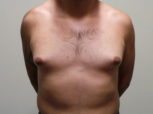 Gynecomastia Patient 06 Before 1