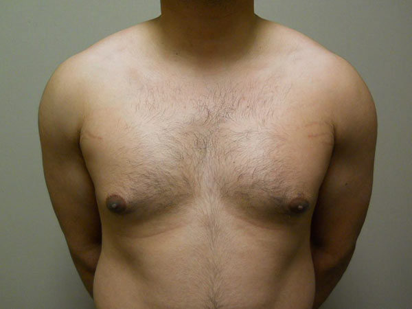 Gynecomastia Patient 05 Before 1