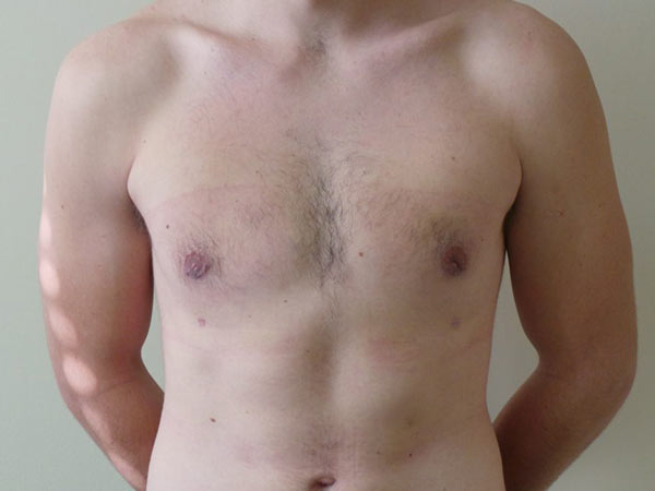 Male Breast Reduction Surgery Patient After