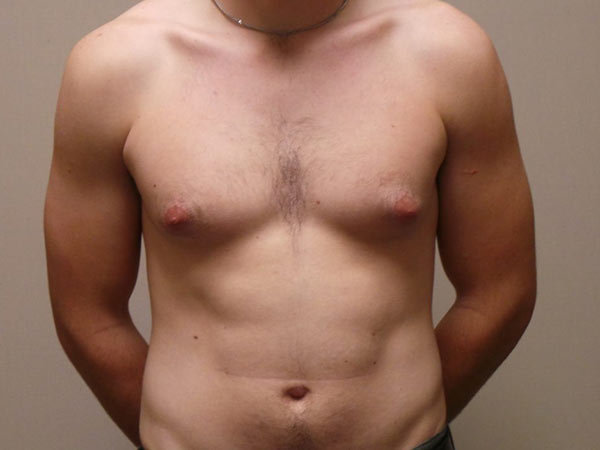 Male Breast Reduction Surgery Patient Before