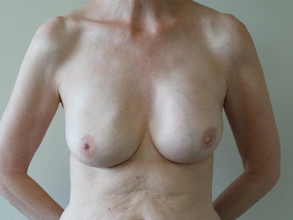 Implant Removal Patient 02 After 1