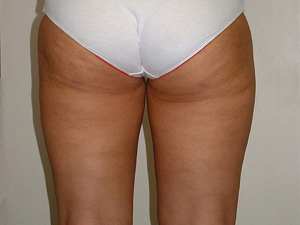 Liposuction Patient 03 After 2