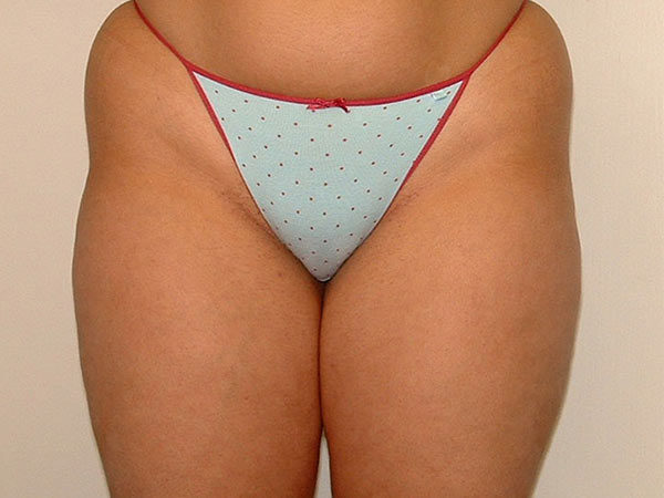 Liposuction Patient 03 Before 1