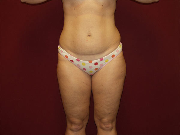 Liposuction Patient 08 Before 1