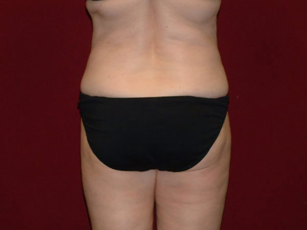 Liposuction Patient 07 After 1