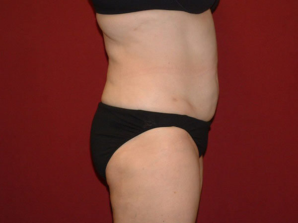 Liposuction Patient 07 After 2
