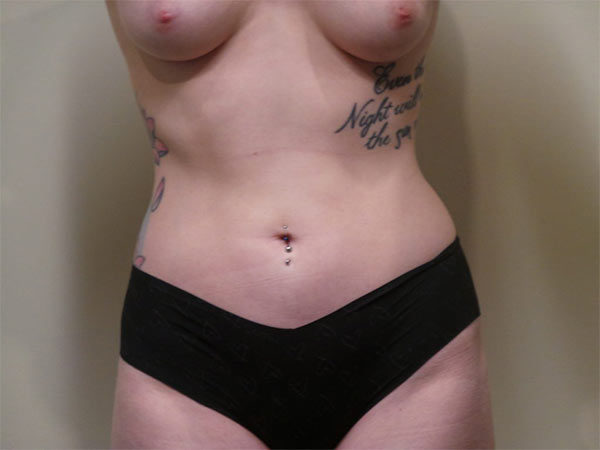 Liposuction Patient 01 After 1
