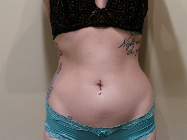 Liposuction Patient 01 Before 1