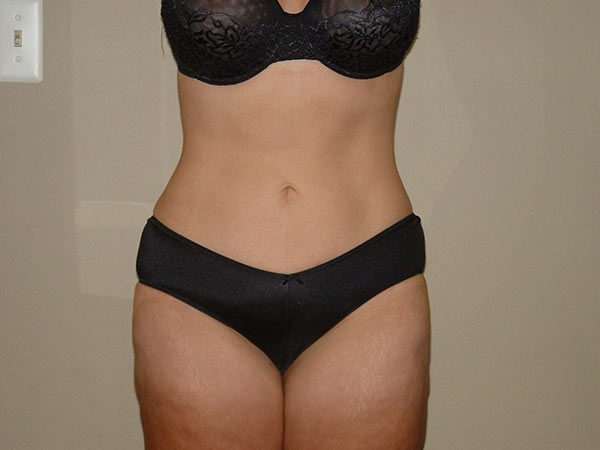 Liposuction Patient 05 After 1