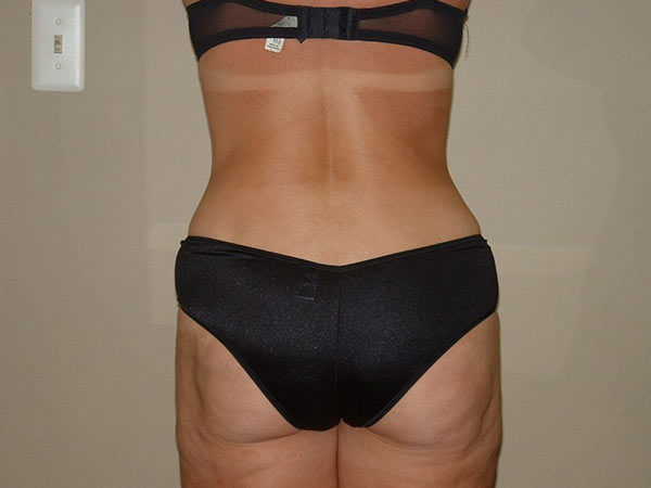 Liposuction Patient 05 After 2