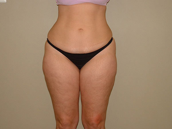 Liposuction Patient 05 Before 1