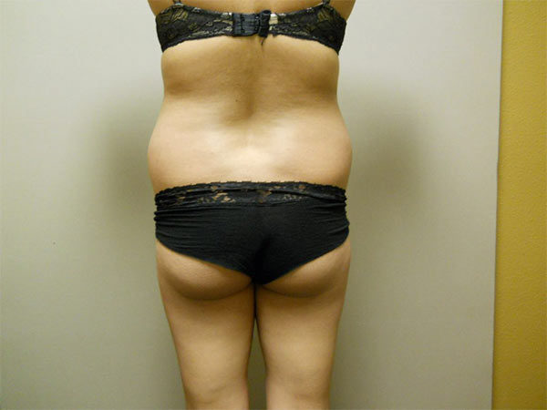 Liposuction Patient 06 Before 2