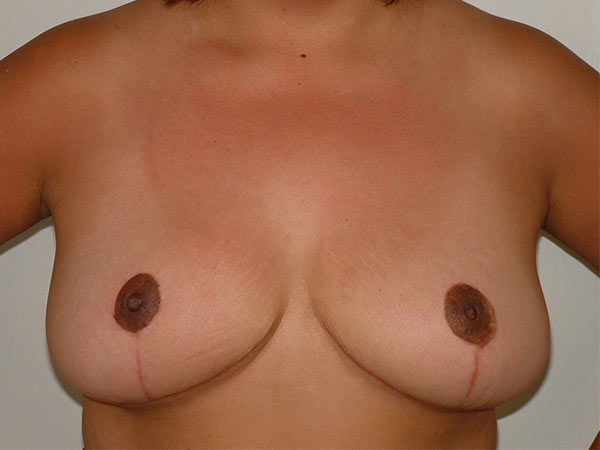 Breast Reduction Patient 08 After 1