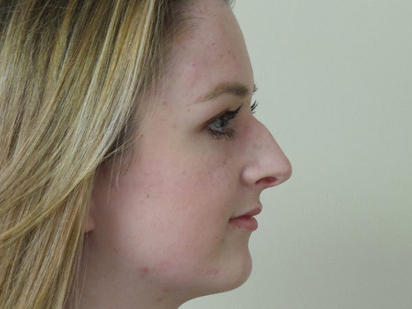 Rhinoplasty Patient 23 Before 2