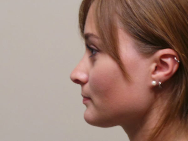 Rhinoplasty Patient 19 After 1