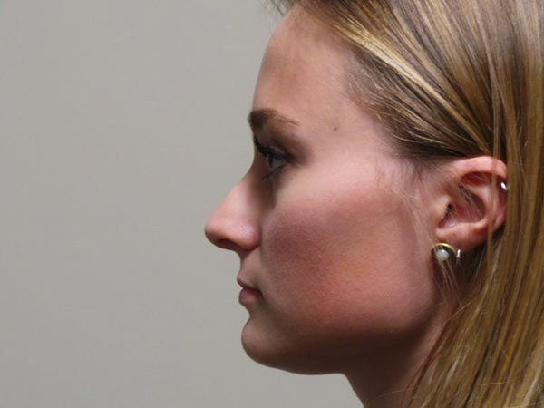 Rhinoplasty Patient 19 Before 1