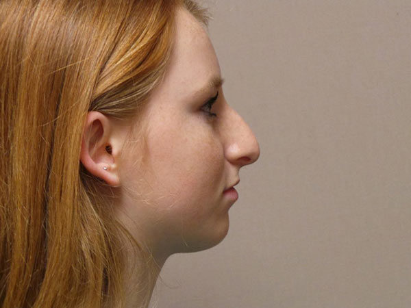 Rhinoplasty Patient 16 Before 1