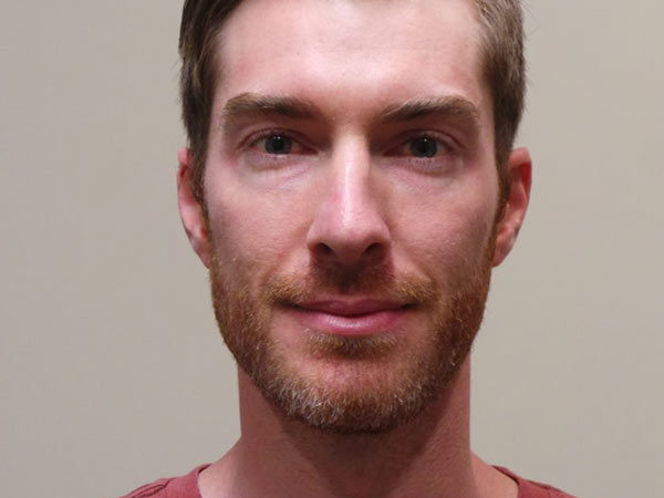 Rhinoplasty Patient 09 After 1