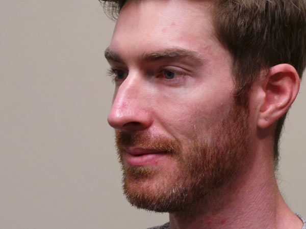 Rhinoplasty Patient 09 Before 2