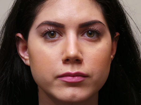 Rhinoplasty Patient 07 After 1