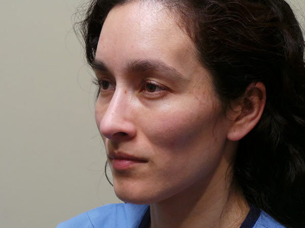 Rhinoplasty Patient 29 After 1