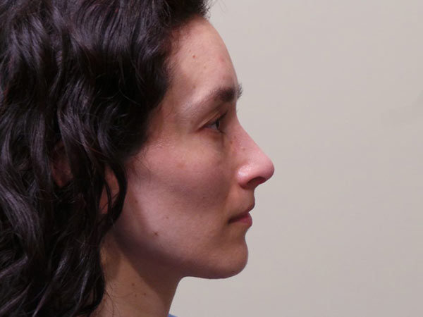 Rhinoplasty Patient 29 After 2