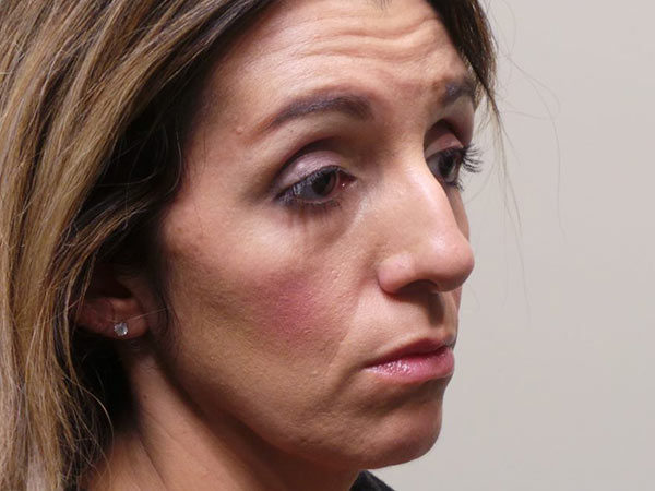 Rhinoplasty Patient 05 Before 1