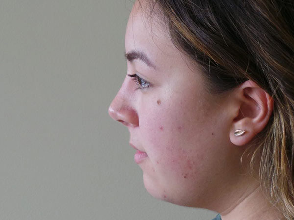 Rhinoplasty Patient 33 After 2