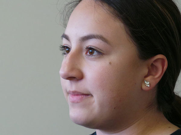 Rhinoplasty Patient 33 Before 1